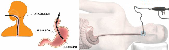 биопсия желудка с помощью эндоскопом