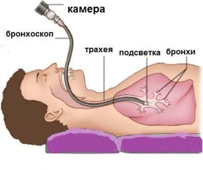 Бронхоскопия как осуществляется процедура