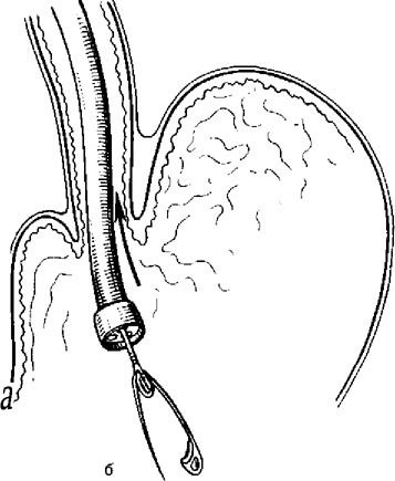 Удаление инородного тела в желудке с помощью эндоскопа